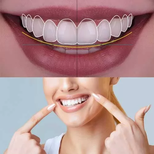 اصلاح طرح لبخند