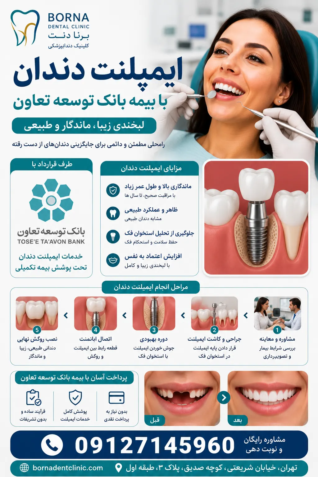 ایمپلنت دندان با بیمه بانک توسعه تعاون