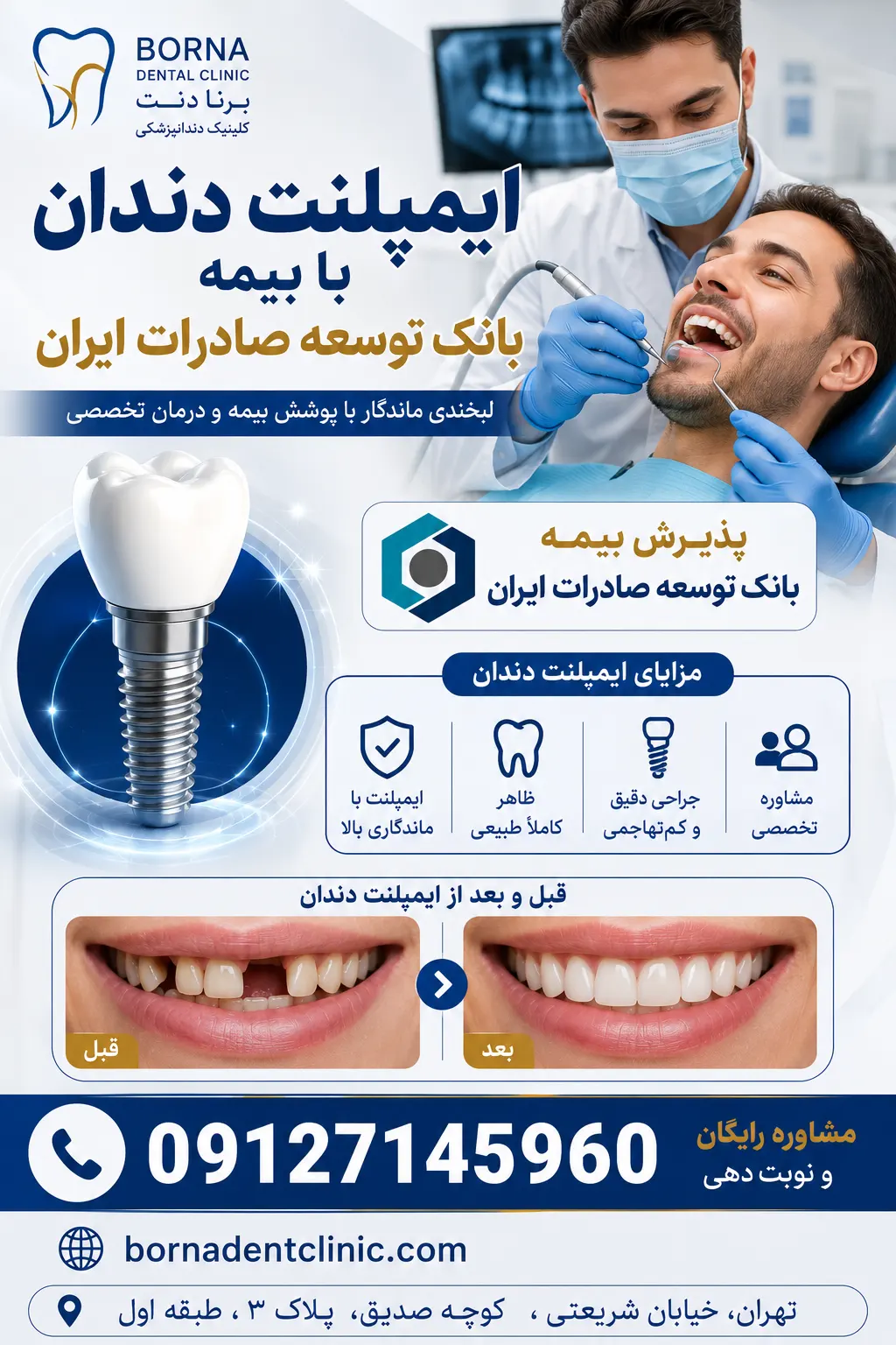 ایمپلنت دندان با بیمه بانک توسعه صادرات ایران
