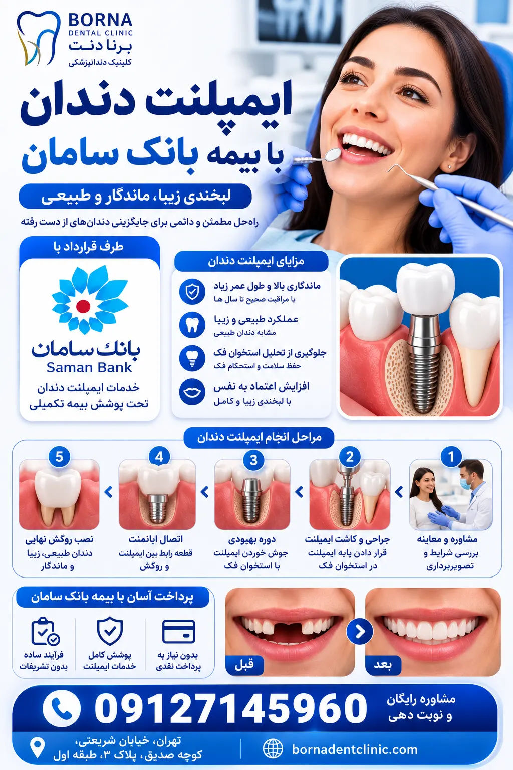 ایمپلنت دندان با بیمه بانک سامان