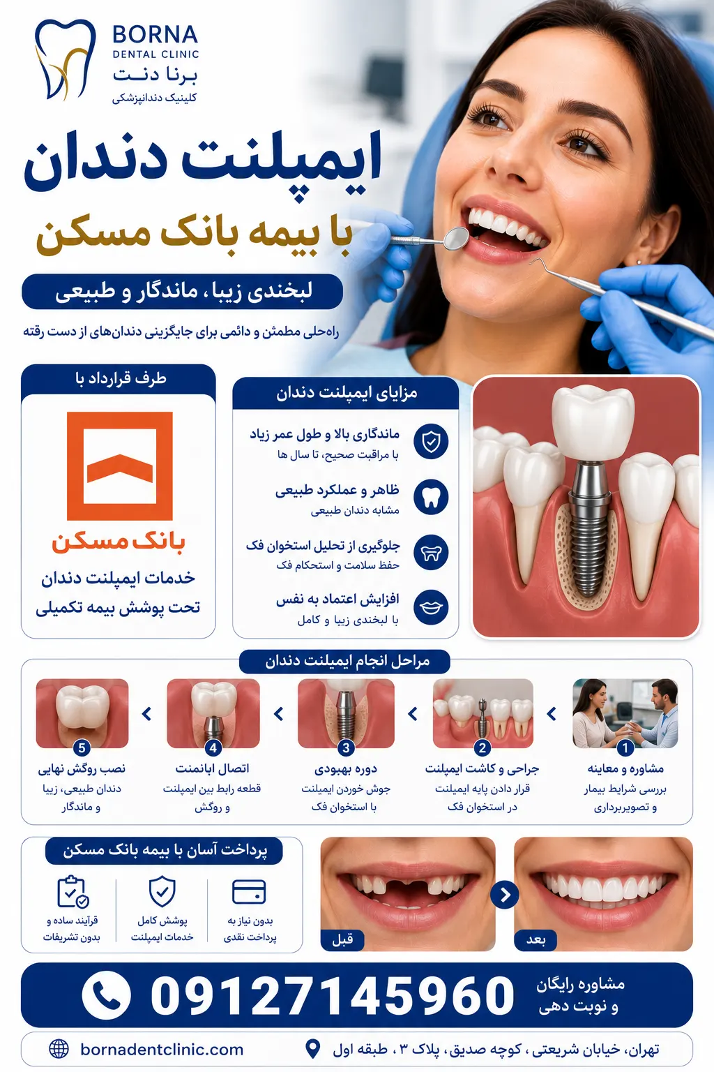 ایمپلنت دندان با بیمه بانک مسکن