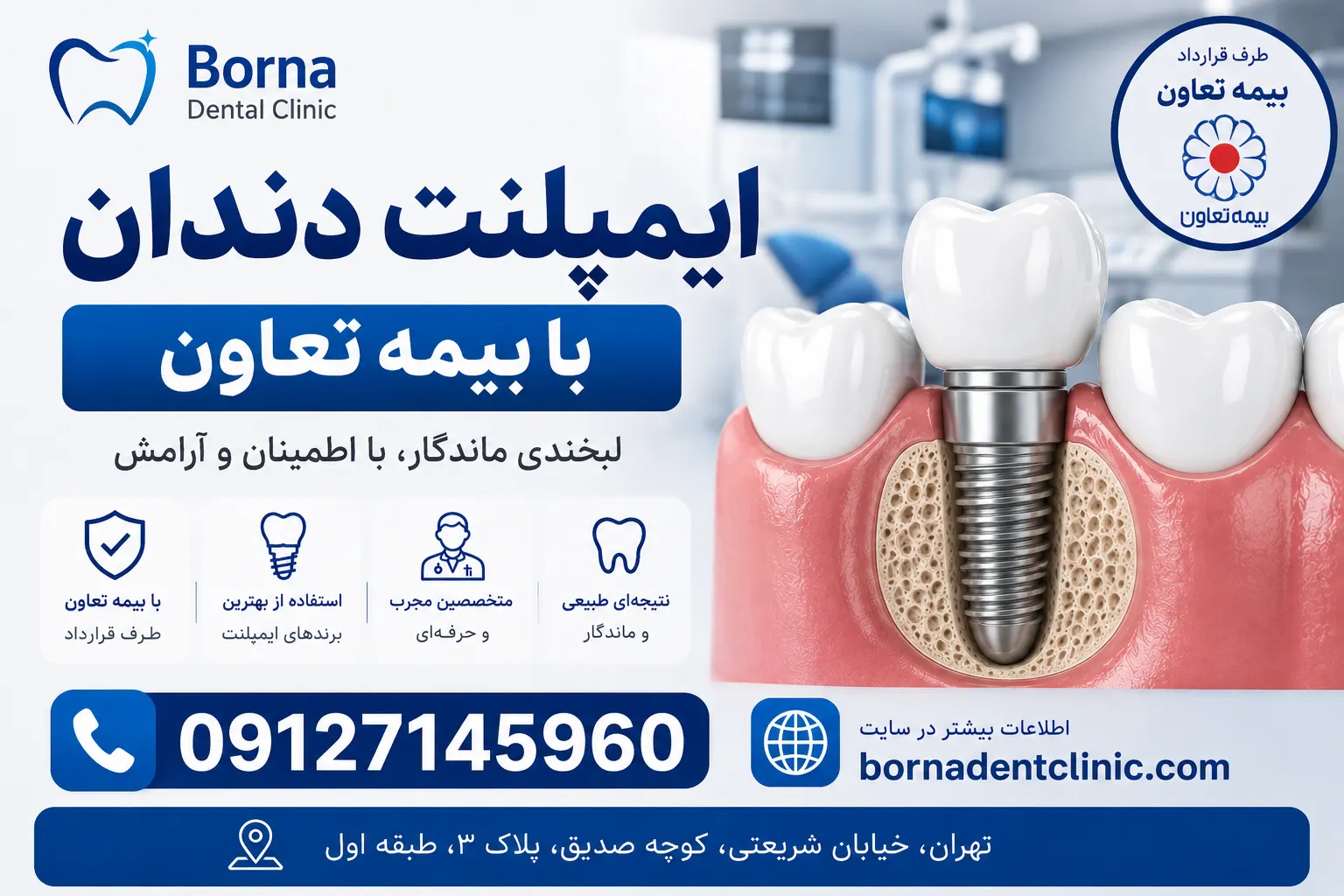 ایمپلنت دندان با بیمه تعاون