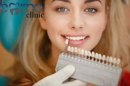 لمینت دندان با بیمه بانک کارآفرین