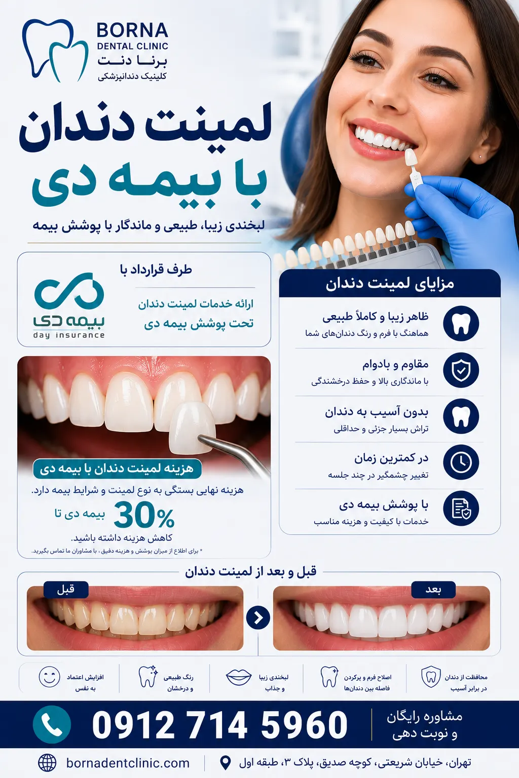 لمینت دندان با بیمه دی