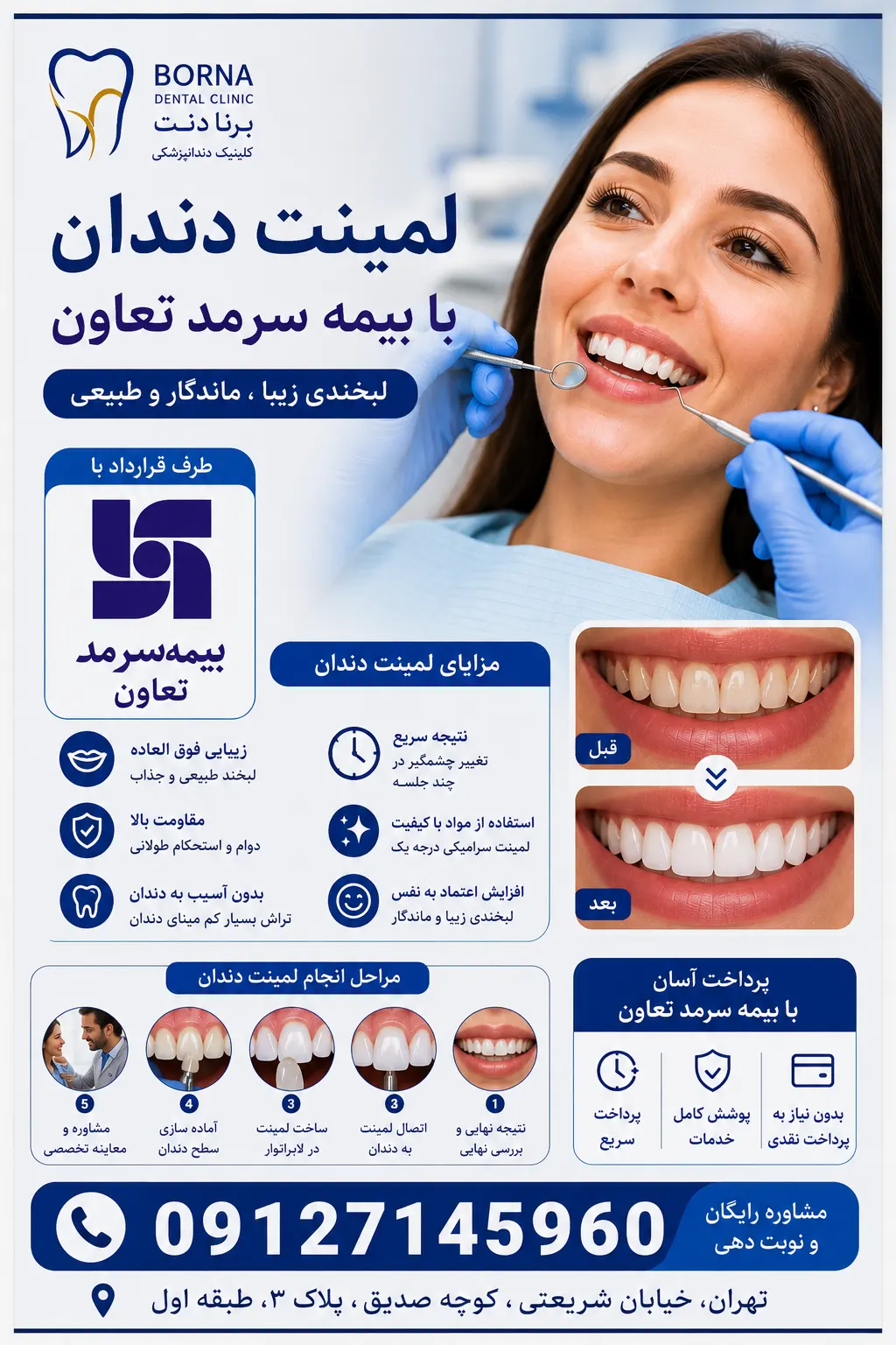 لمینت دندان با بیمه سرمد