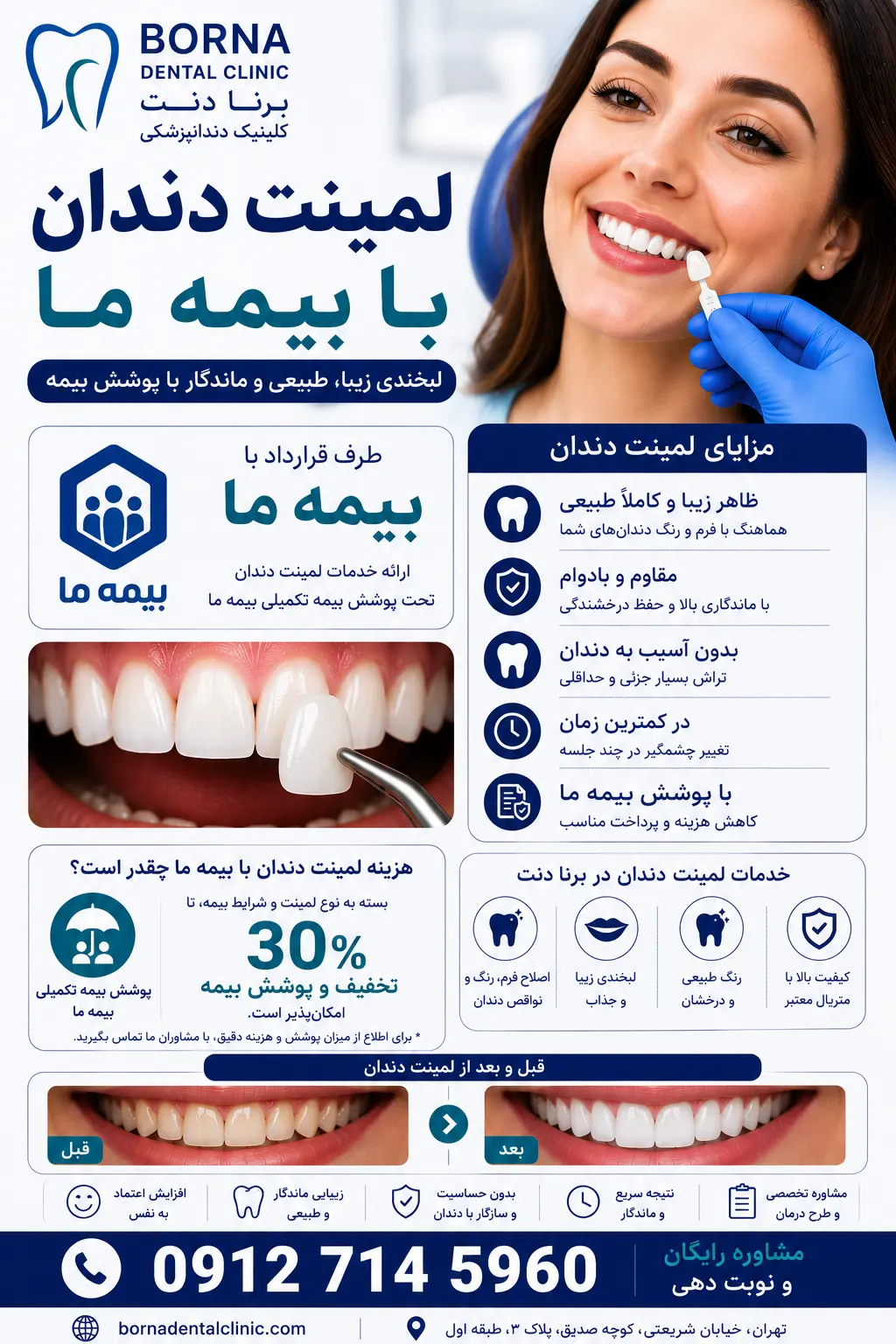 لمینت دندان با بیمه ما