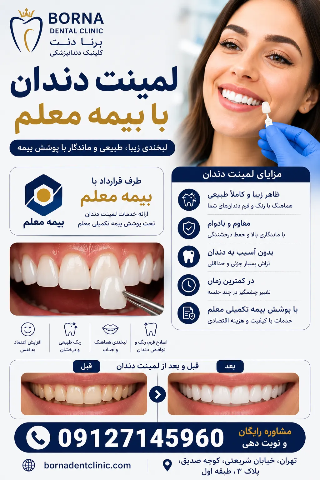 لمینت دندان با بیمه معلم