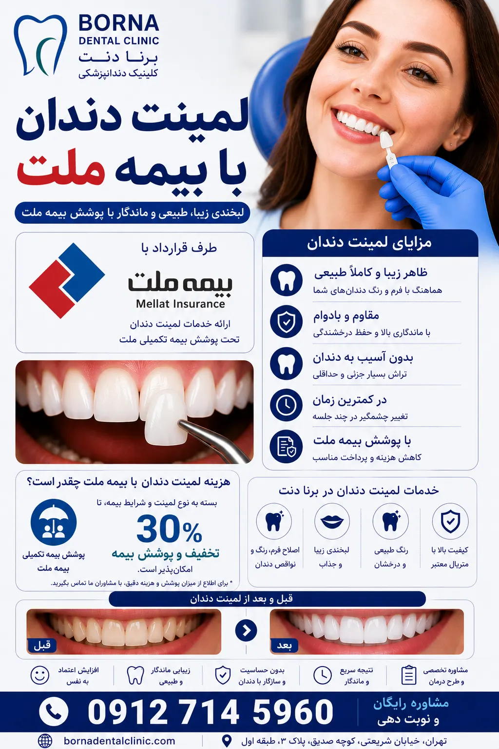 لمینت دندان با بیمه ملت