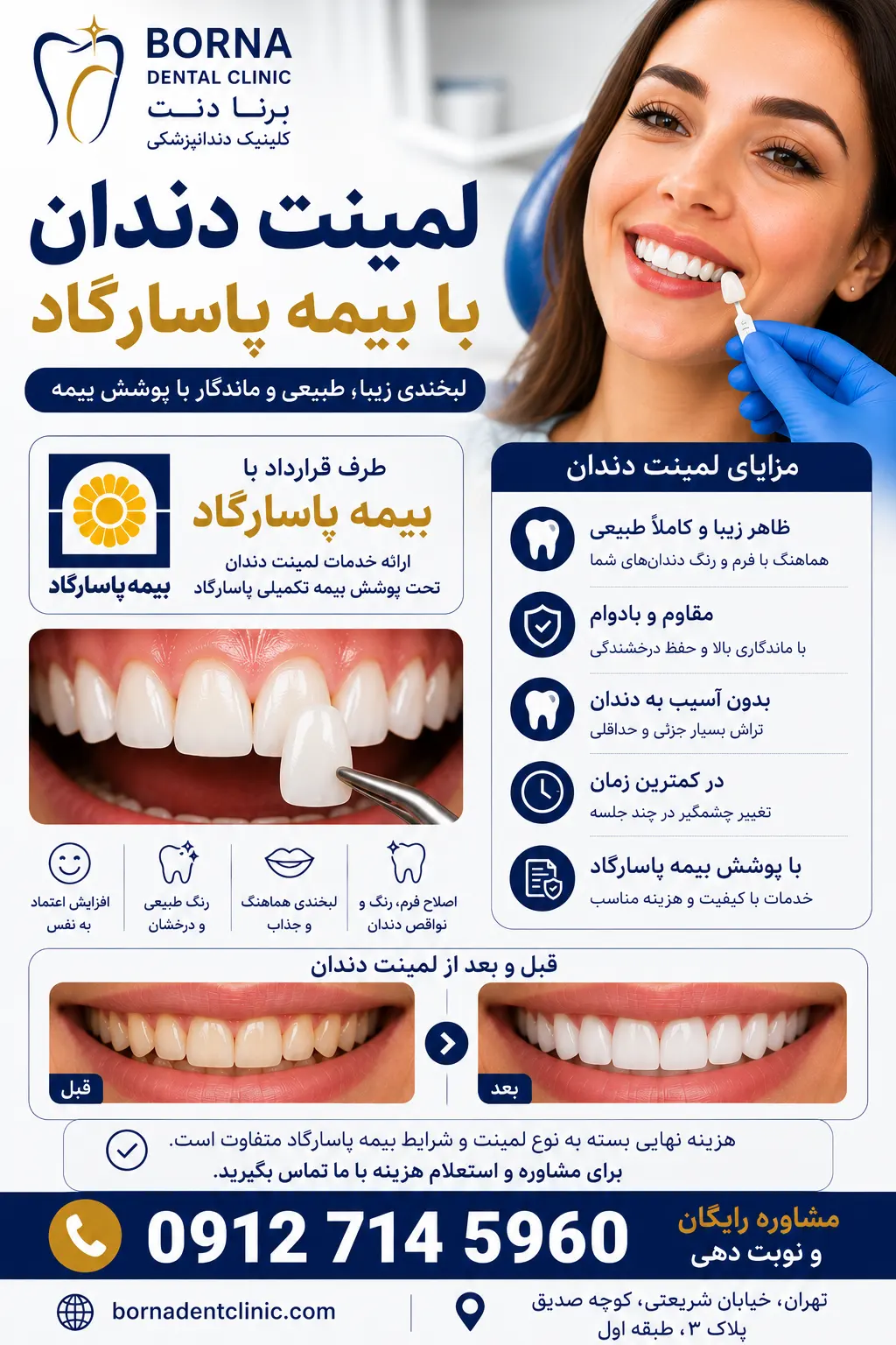 لمینت دندان با بیمه پاسارگاد