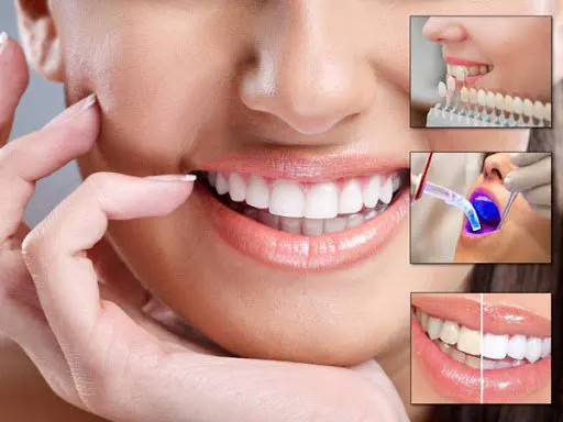 لمینت دندان با بیمه پاسارگاد