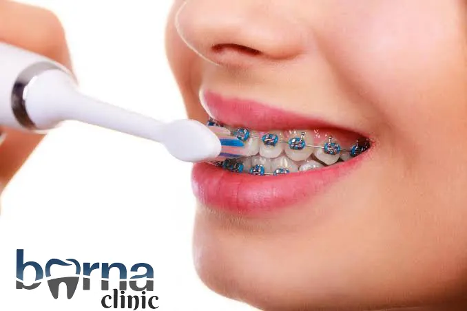 ارتودنسی با بیمه میهن