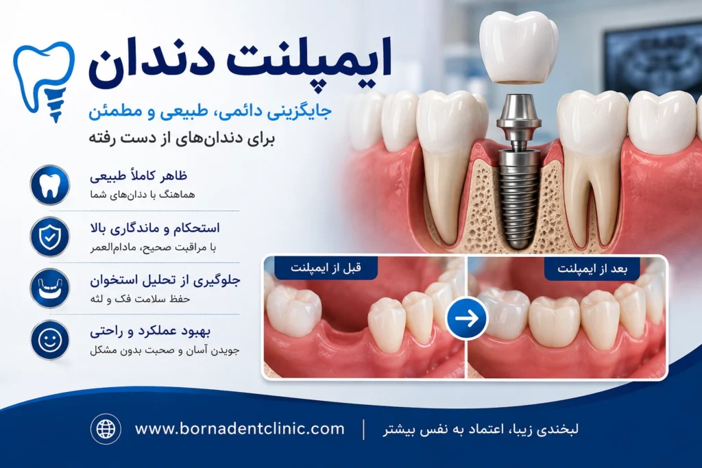 ایمپلنت دندان با بیمه ایران