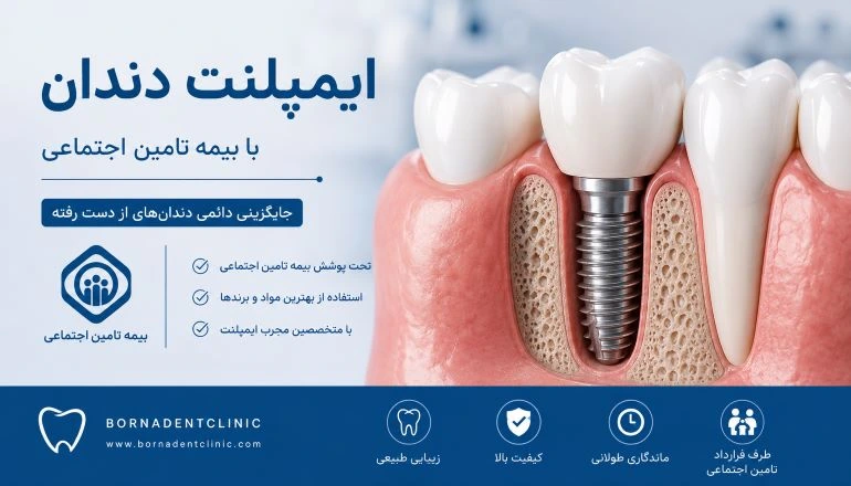 ایمپلنت دندان با بیمه تامین اجتماعی