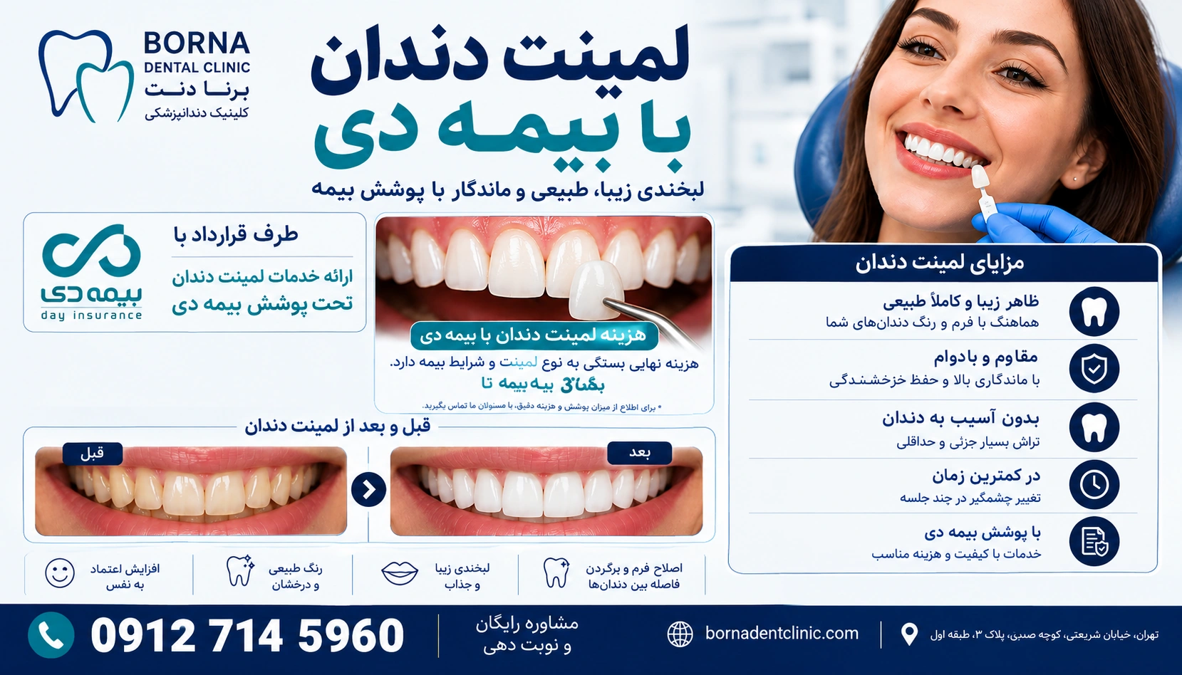 لمینت دندان با بیمه دی